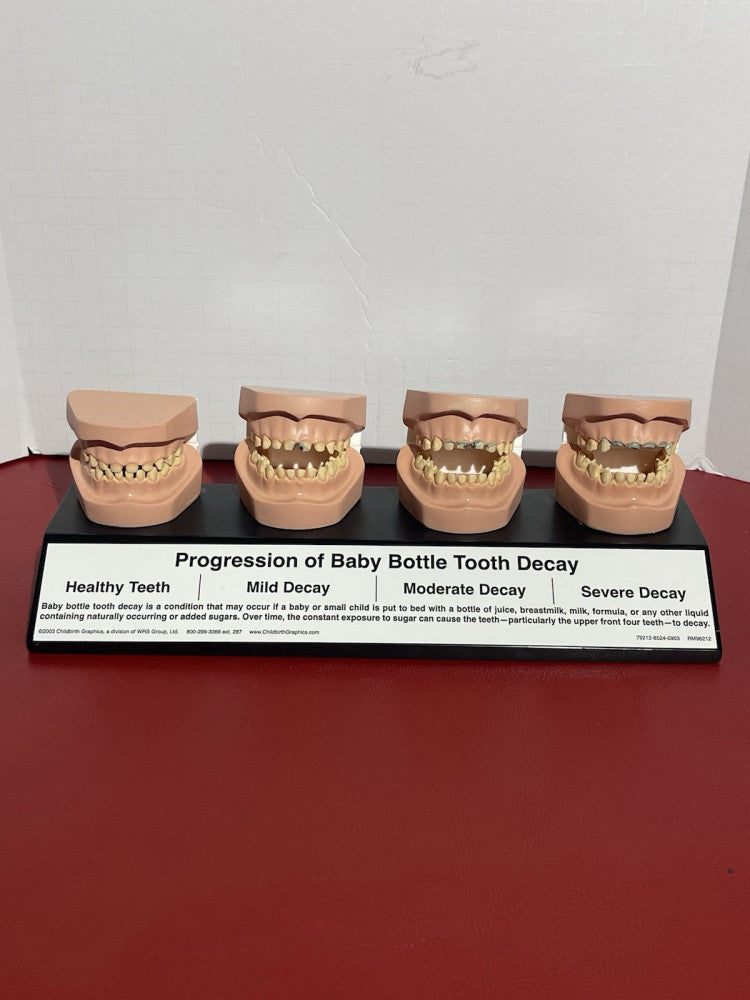 2003 Progression of Baby Bottle Tooth Decay Dental Anatomical Model Anatomy